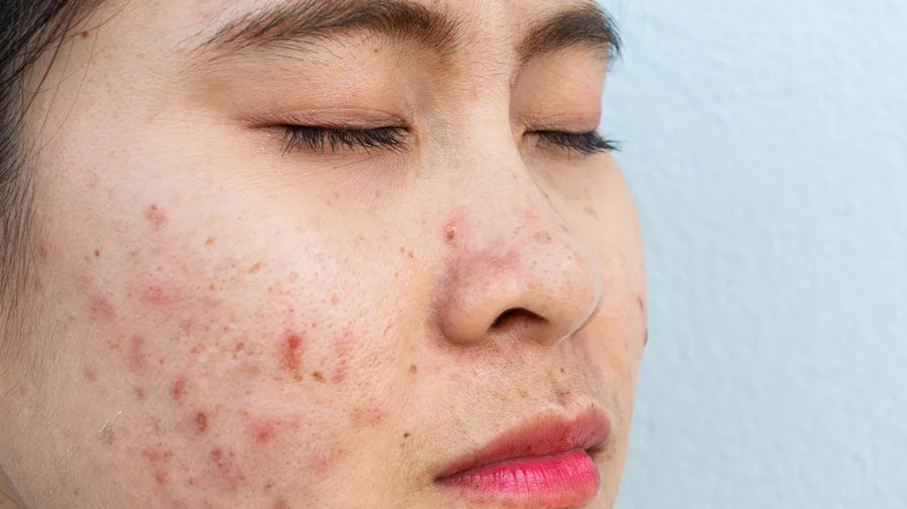 acne-vulgaris-body1